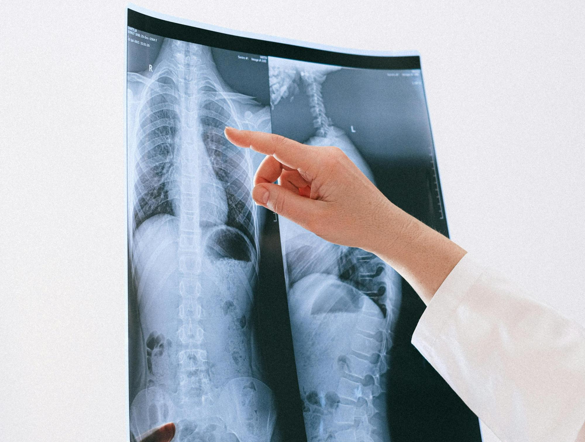 Фтизиатрия (ересектер, балалар)